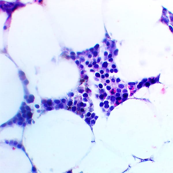 HHV-6 Immunohistochemical staining-Bone Marrow 