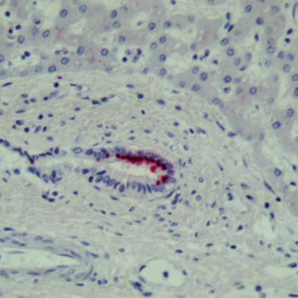 IHC - HHV-6 in Liver Duct